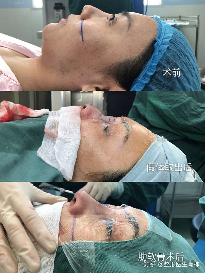 假体隆鼻取出之后鼻子会比原来的更塌吗?