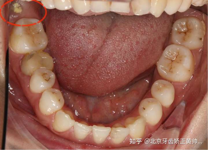 是6号牙因为大面积龋坏需要拔除,检查后发现可以实现智齿前移代替磨牙