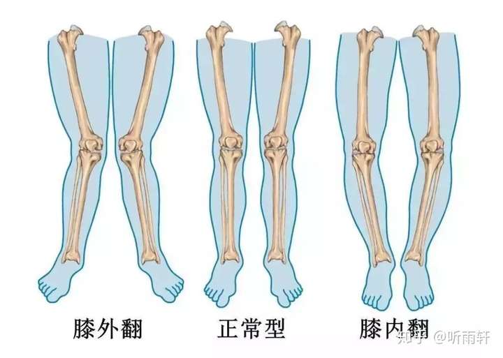 左一是膝外翻,即x型腿