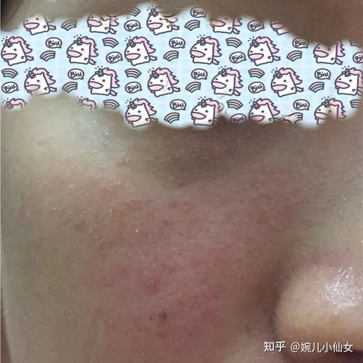 皮肤敏感容易红角质层薄毛孔粗大怎么办