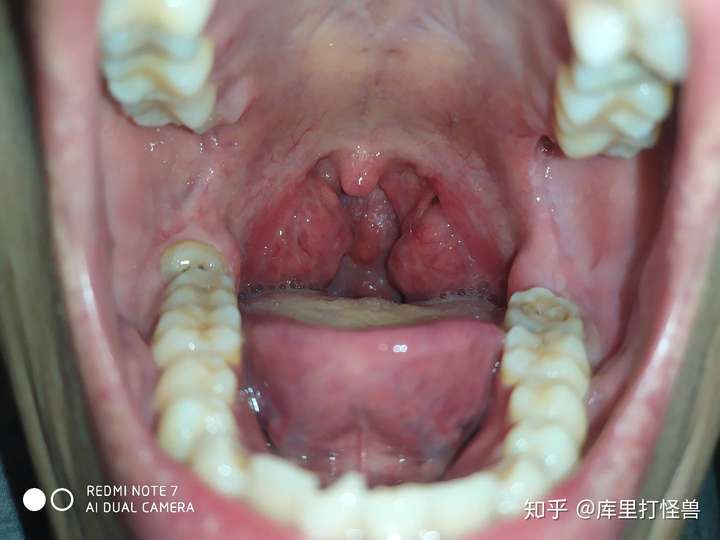 切扁桃体之后是什么感觉?