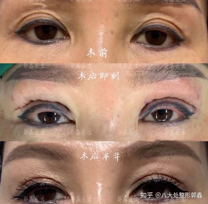可能是上眼睑松弛导致的,可以尝试进行双眼皮手术,取出多余的皮肤进行