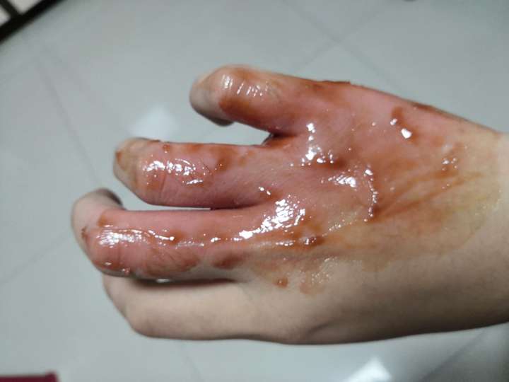 手被水蒸气烫伤,怎么处置?
