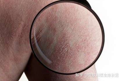 银屑病光疗费用和效果如何