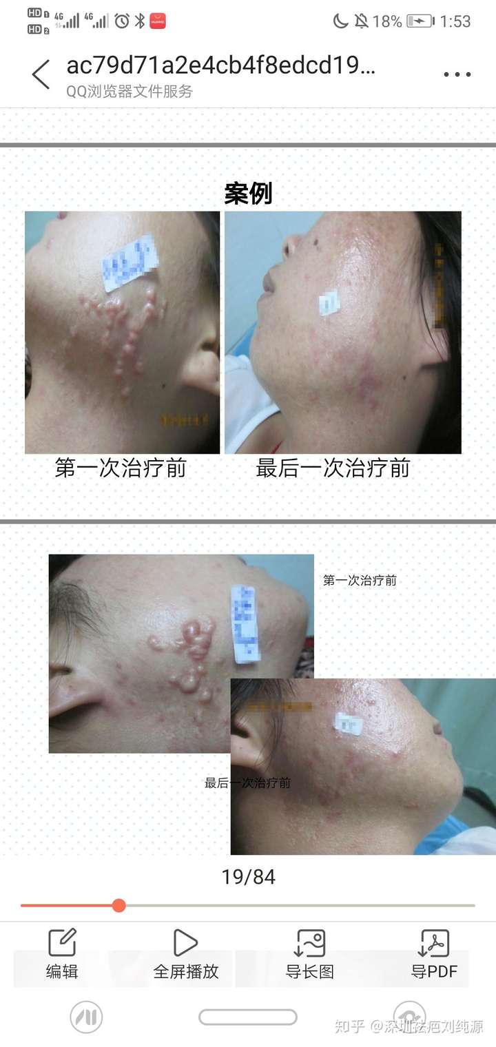 痤疮瘢痕疙瘩如何有效去除?