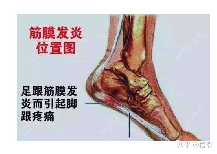 足底筋膜炎什么症状