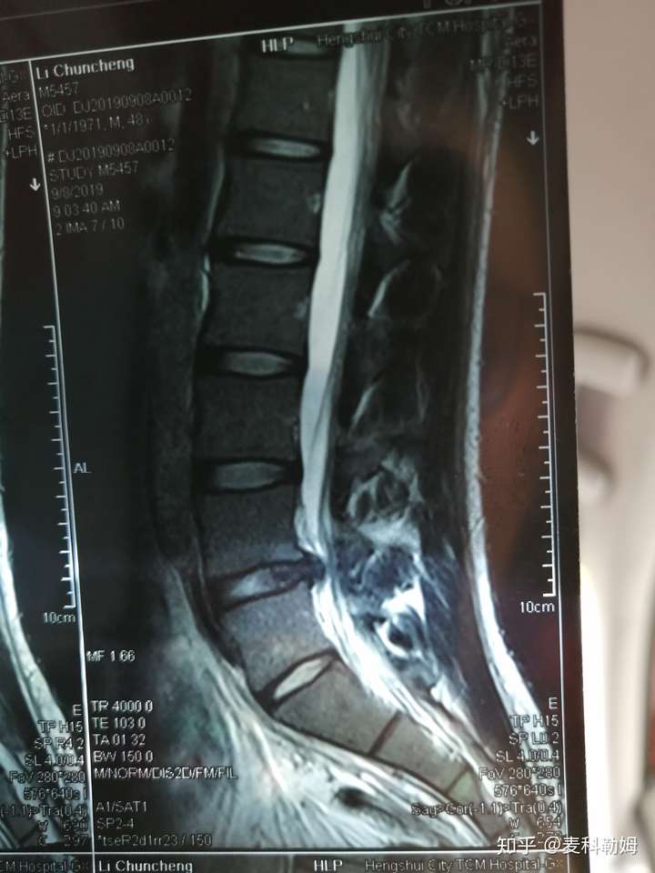 22 岁患了腰椎间盘突出,目前心灰意冷,即将面临毕业,该怎么办?