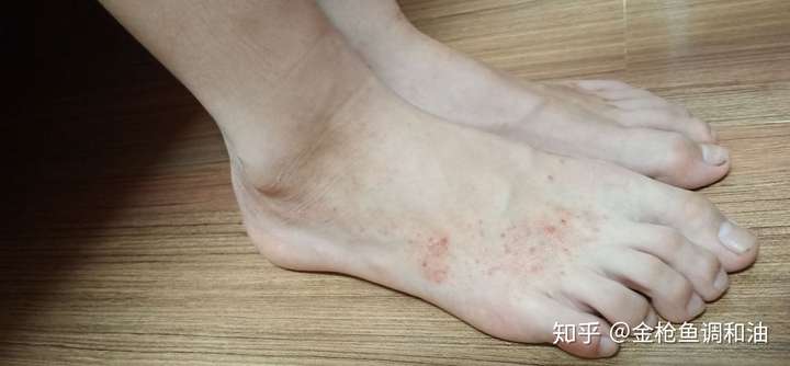 连续四年,每到夏天双脚脚面就犯湿疹,有没有办法根治?