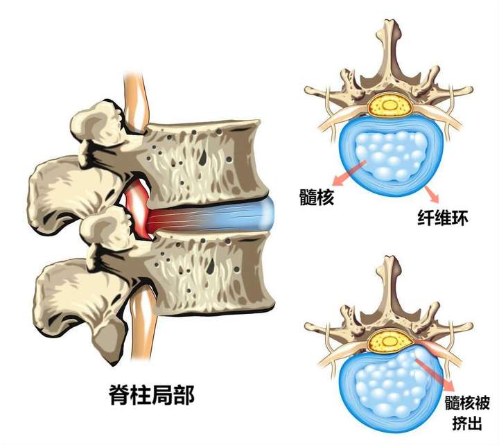 成年人的脊柱共有26块椎骨(颈椎7块,胸椎12块,腰椎5块,骶骨,尾骨各一