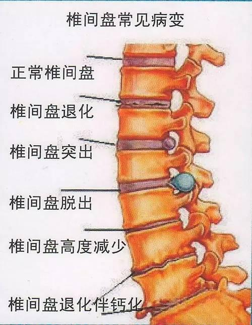 腰椎间盘突出现在弯腰的时候会有轻微疼痛感有什么专项训练动作嘛