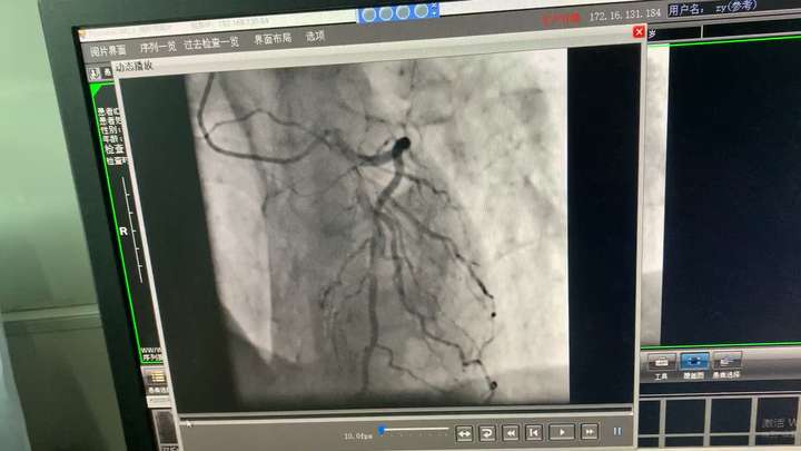 心血管内科 心脏支架 支架手术 心脏造影 冠脉造影 关注者 1 被浏 