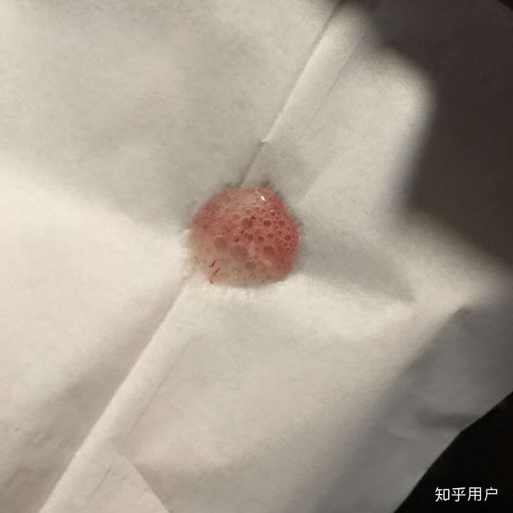 每天早上起床后喉咙经常性出血,一定是慢性咽喉炎么?