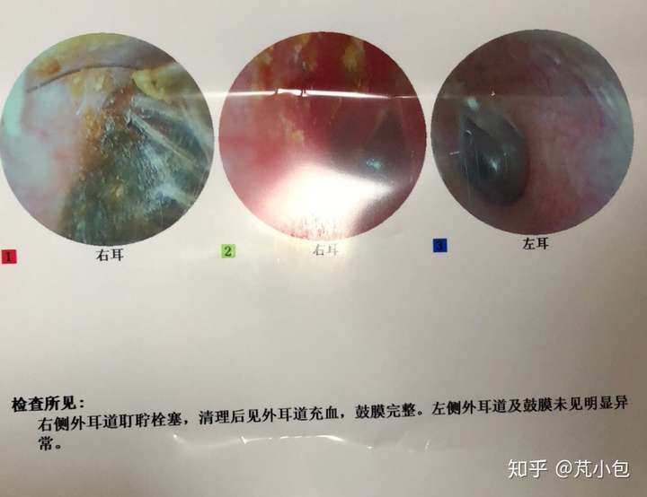 我老公马不停蹄的又奔向了总院,拍了片子,医生用一个小器械敲