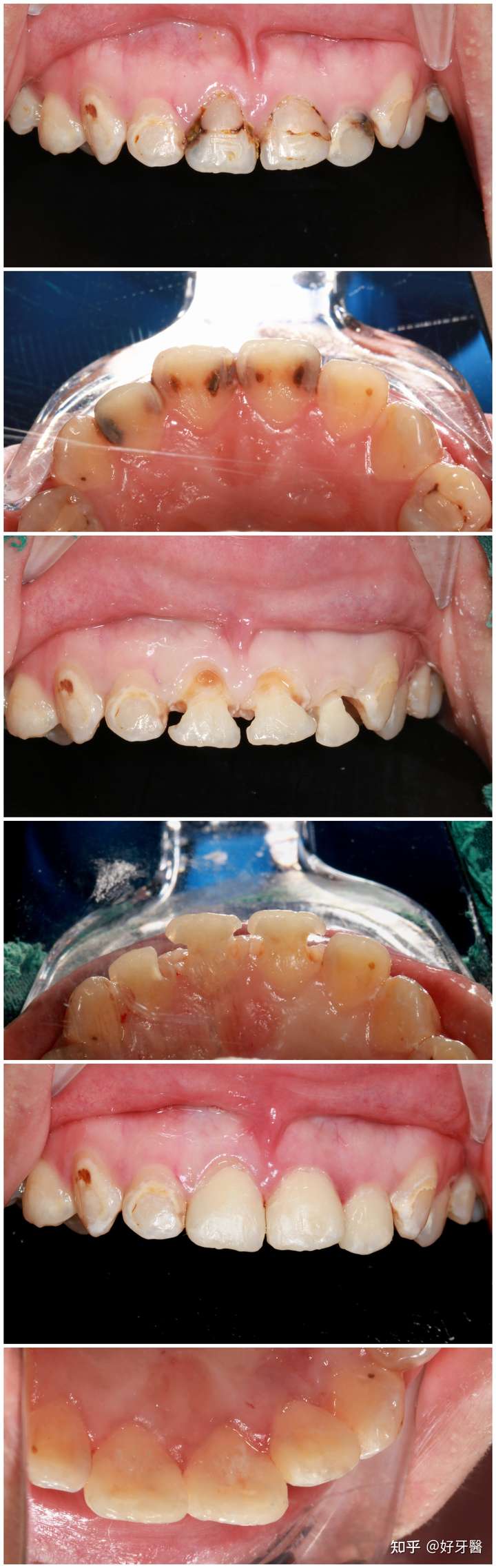 严重的龋齿也可以用树脂补牙材料补得很美观,不需要根管治疗加牙冠.
