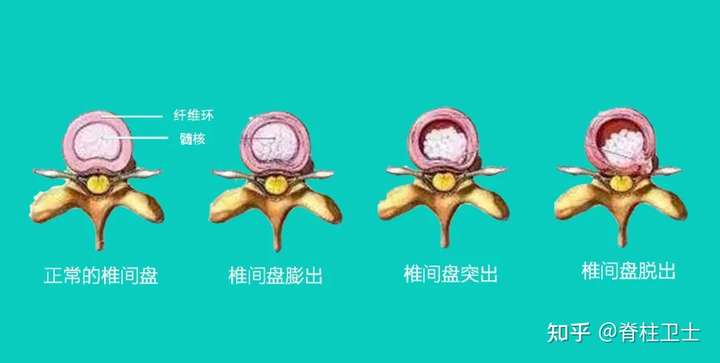 腰间盘突出可以恢复到拍片看不出来吗?