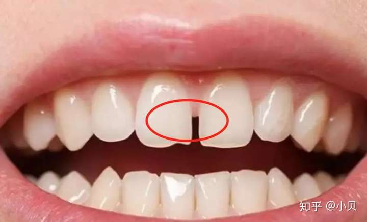 譬如牙齿突的话,牙齿倾斜角度过大,咬合力的传导下前牙牙缝就会越来越