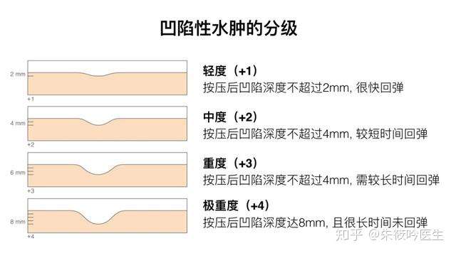 下肢水肿的诊断思路推荐收藏