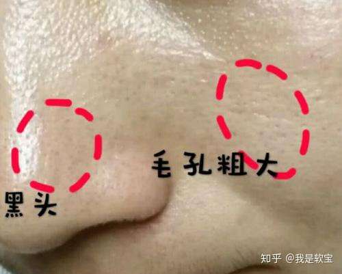 用完清洁面膜浮出的白头黑头应该如何处理?