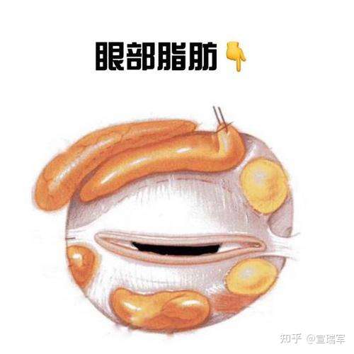 上眼皮脂肪怎么减少?