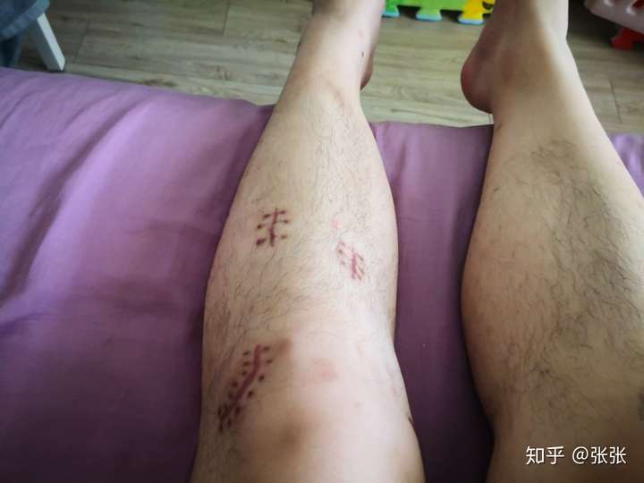 这是我做手术的腿 因为肌肉萎缩基本上比右腿小了一圈