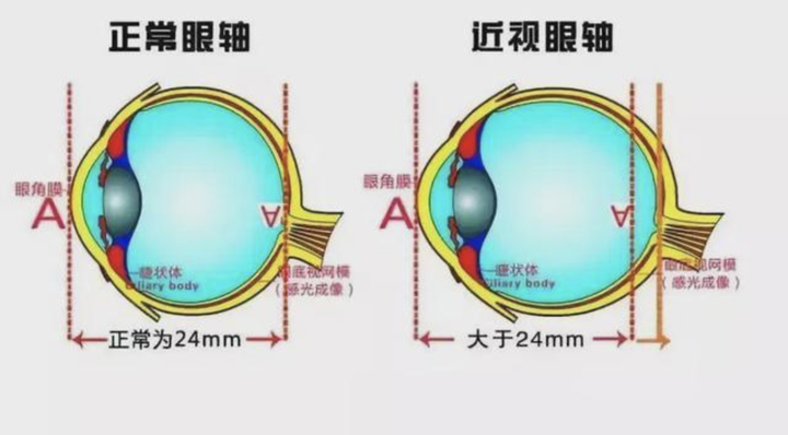 近视是因为眼球变长,那么近视的人经常向内挤压眼球,就能把眼睛按回去