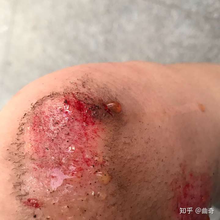 皮肤破后,流血结痂愈合是一个怎样的过程?
