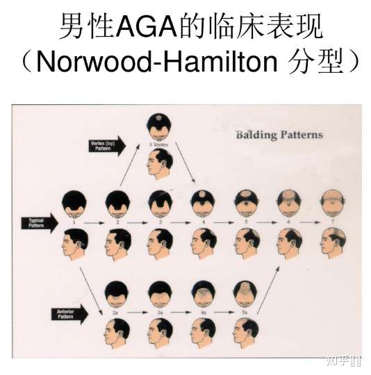 其实不严重哒~ 目前国际上男性型脱发分为汉密尔顿分型(hamilton