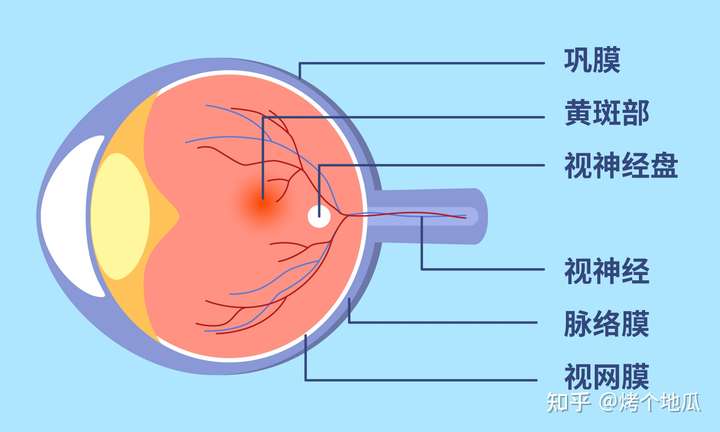 眼前漂浮物增多是典型的症状之一,其他症状还包括眼睛发红,眼痛,视野