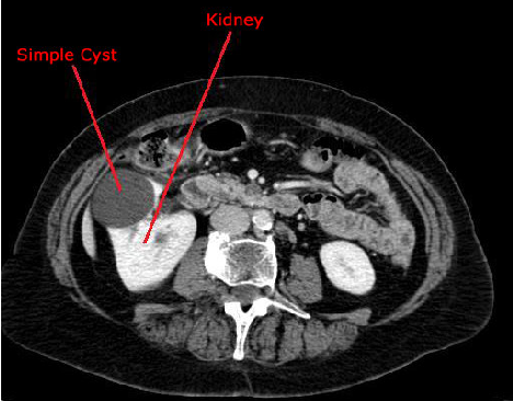 单纯性肾囊肿ct图像