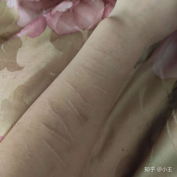 不会 去年抑郁症发作 忍不了自己割的 现在已经好了 不想看到别人好奇