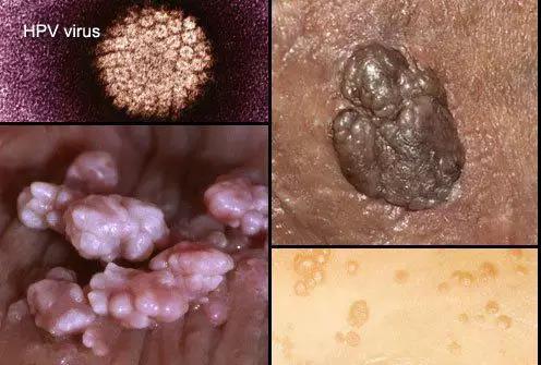 人乳头瘤病毒的电镜照片以及导致皮肤疾病症状(图片来源:中国科学院微
