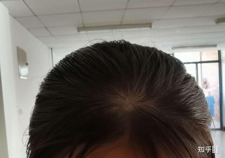 头顶这个发量正常吗