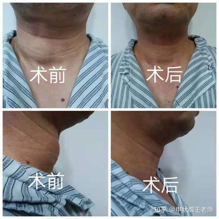 甲状腺结节去除手术的方案有哪些?各自有什么优缺点?适应范围如何?