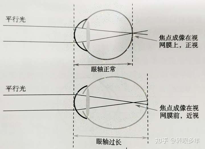 孩子配眼镜需要测眼轴,需要使用生物测量仪吗?