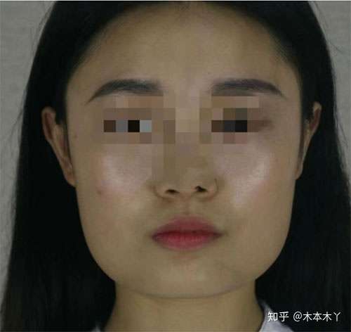 怎么判断自己脸大是咬肌大还是骨头大