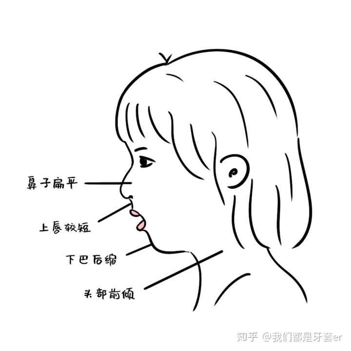 很严重的口呼吸面容,该怎么办?