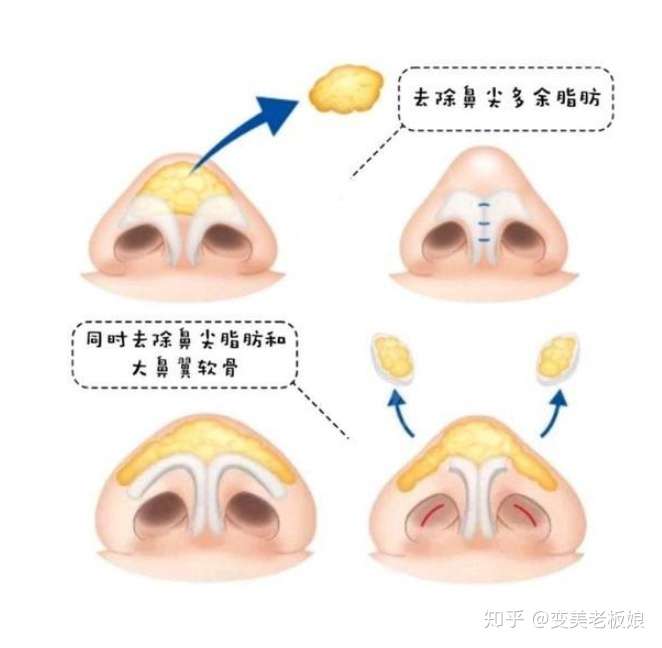 鼻头缩小的方法包括了 鼻头组织祛除和 鼻翼软骨缝合.