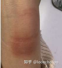 有没有果粉戴applewatch6海军蓝标配硅胶表带过敏的呢