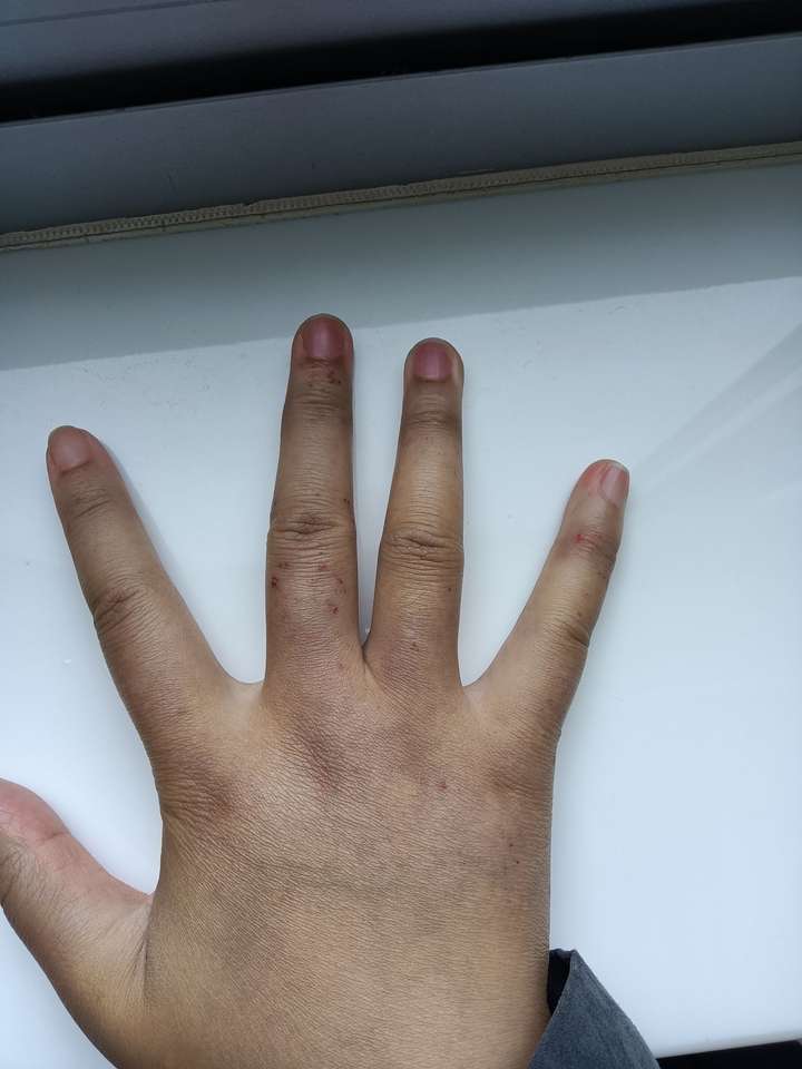 手上因为冻疮长的这些红疙瘩到底是什么东西?好多年都