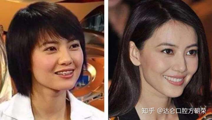 22岁牙齿矫正算不算晚?