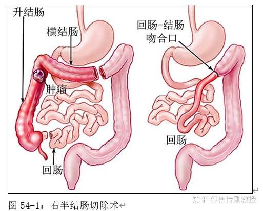 右半结肠切除术(图54-1)