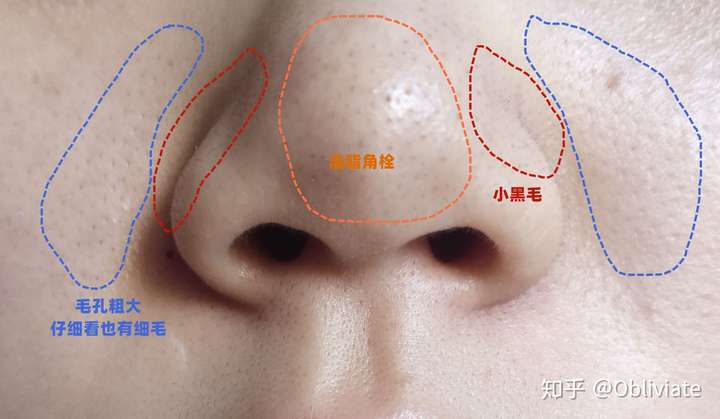 我这个黑头毛孔怎么改善呀,毛孔里还有黑毛,有些绝望呀?