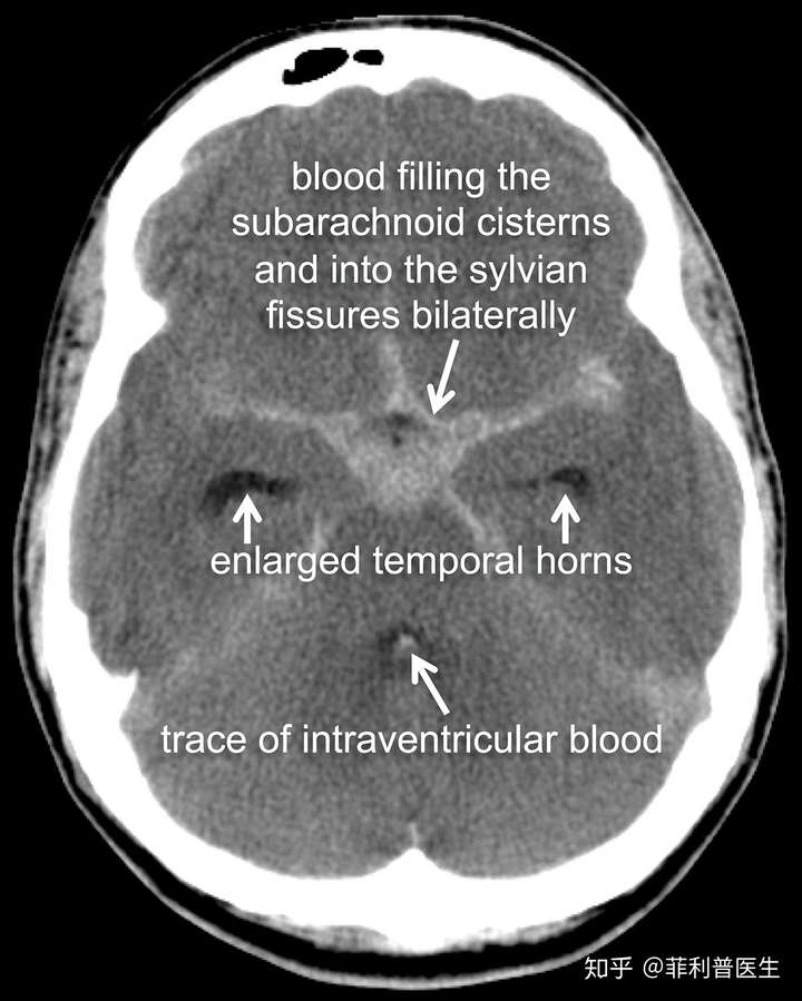 典型的蛛网膜下腔出血ct扫描图像,本应是黑色的大脑沟中填满了发白的