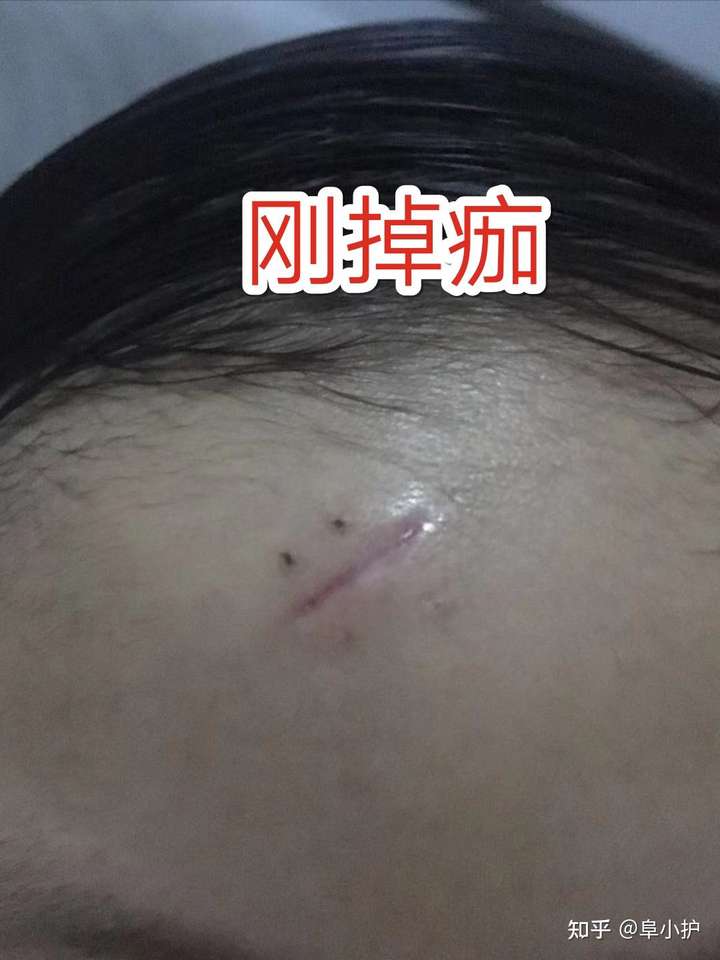 指定是芭克了 这个小朋友是缝针术后,应该比题主形容的划伤要严重些了