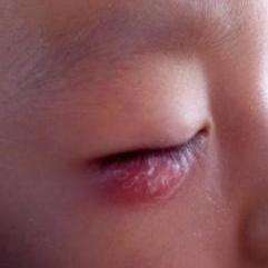 针眼,又称偷针眼 或 麦粒肿,是一种在睫毛底部皮脂腺母感染.
