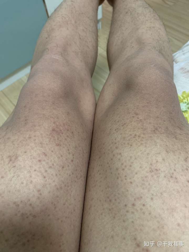 从初中的时候开始胳膊上就有密密麻麻的小疙瘩,人比较黑,所以看着也