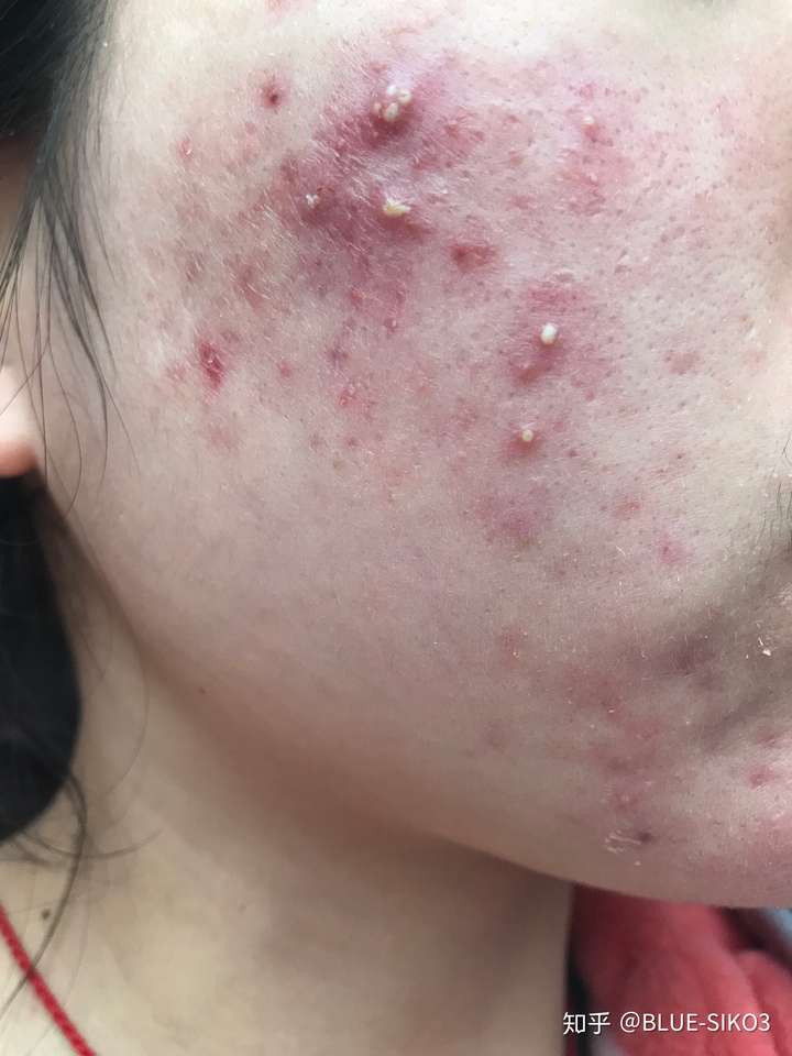 脸上的痘痘快两年了,还伴有脓肿粉刺,有什么解决方案吗?