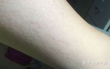 生长纹太多了.是什么问题?