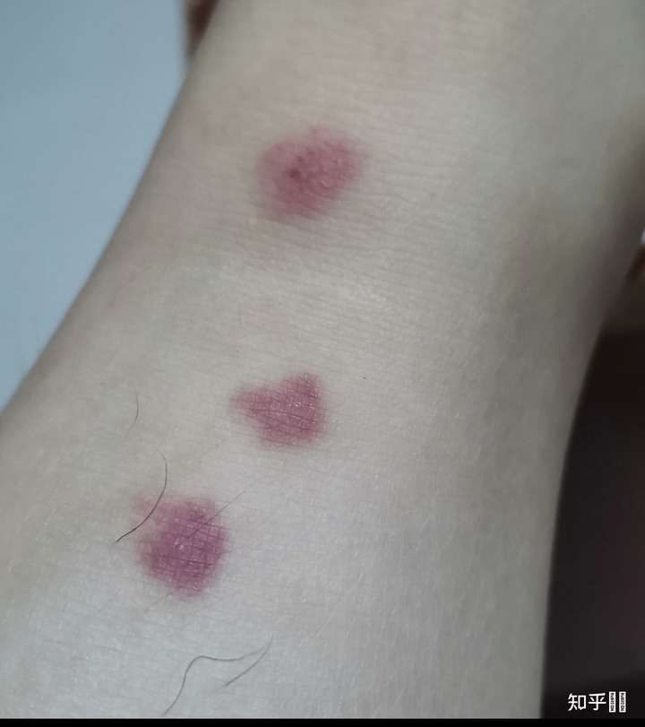 为什么我被蚊子咬了之后皮肤会变成类似淤青的紫红色