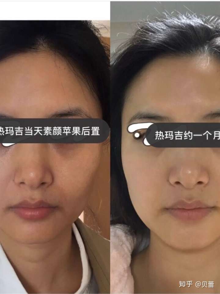 做热玛吉有啥副作用?